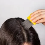 Cara Menghilangkan Kutu Rambut